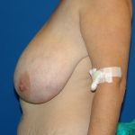 μείωση στήθους περιστατικό 9 πριν αριστερό προφίλ