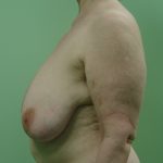 μείωση στήθους περιστατικό 29 πριν αριστερό προφίλ