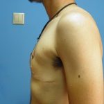 Γυναικομαστία μετά από απώλεια βάρους. Υποδόρια μαστεκτομή και αποκατάσταση με τη τεχνική της Lτομής -6