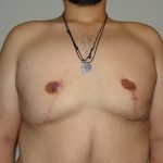 Γυναικομαστία σε συνδυασμό με βραχιονοπλαστική σε ασθενή με μεγάλη απώλεια βάρους -2