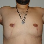 Γυναικομαστία σε συνδυασμό με βραχιονοπλαστική σε ασθενή με μεγάλη απώλεια βάρους -8